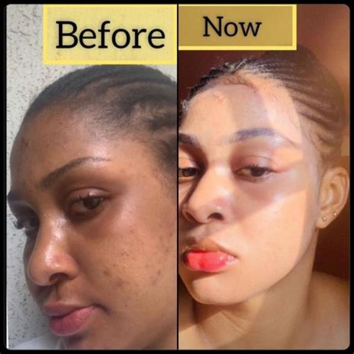 Sharon Ooja Before Bleaching: A Journey of Transformation